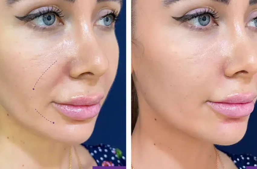  Smooth Out Wrinkles with Nasolabial Fold Filler