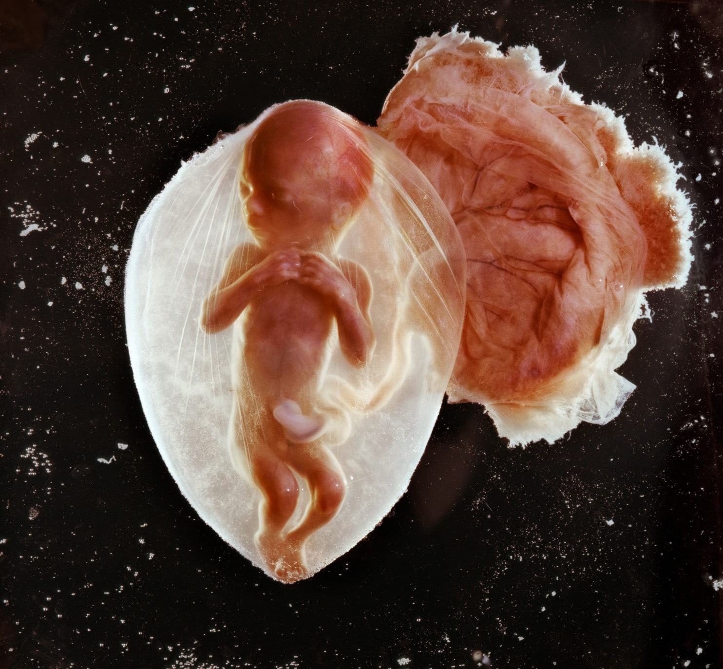 foetus_19651486060741.jpg (1484Ã1373)